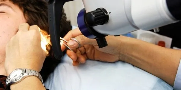 Micro-Suctioning procedure